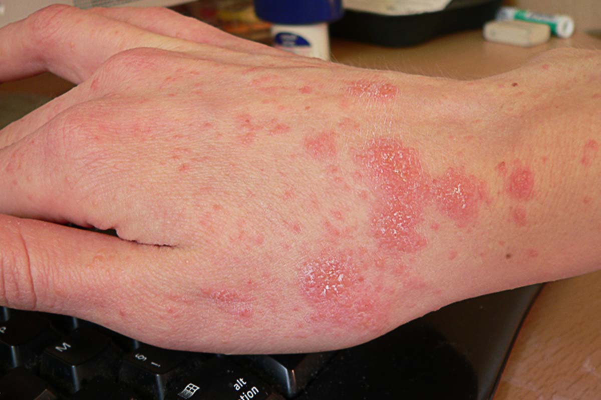 IL RITORNO DELLA SCABBIA - anteprima post